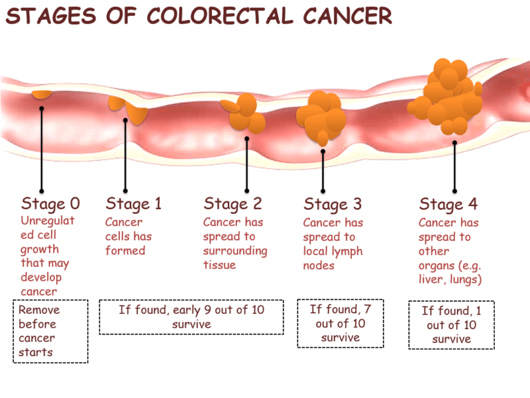 Stages of colorectal cancer