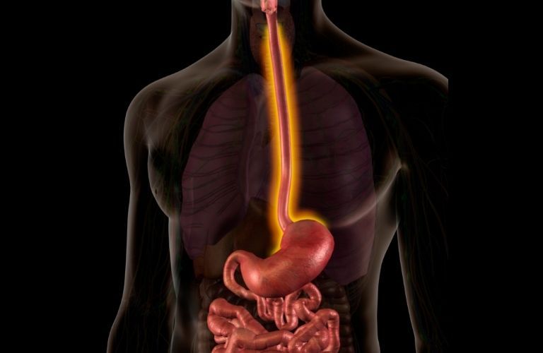 What is Esophagus Surgery or Esophagectomy?