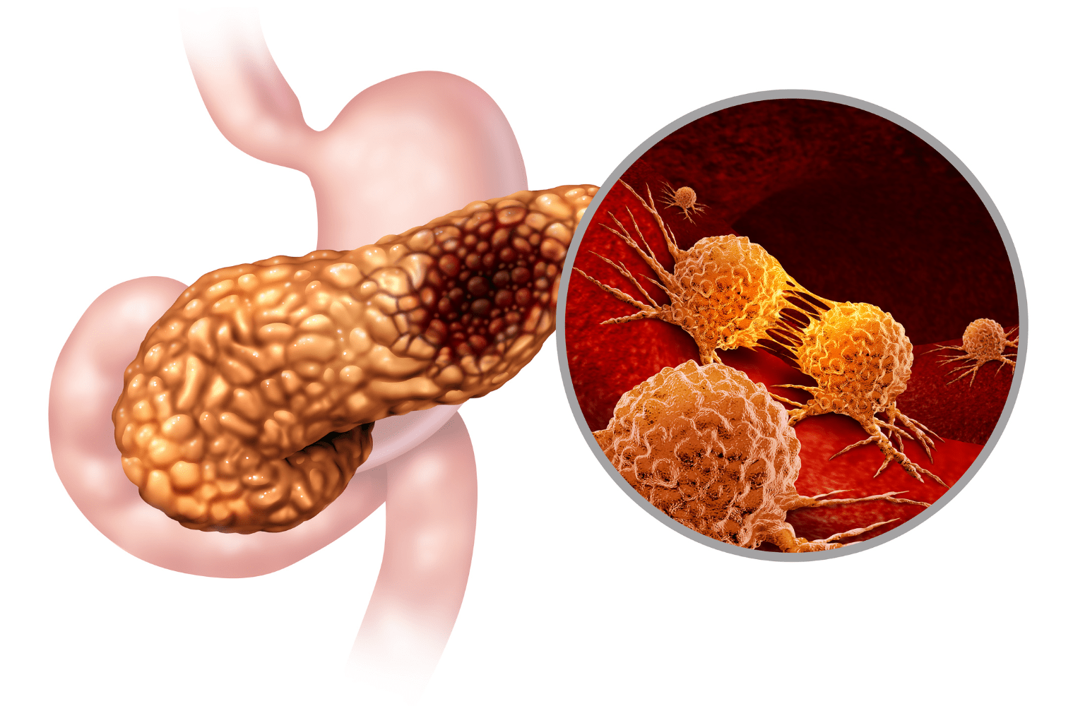 Acute Pancreatitis Symptoms Treatment Causes Dr Dhaval Mangukiya