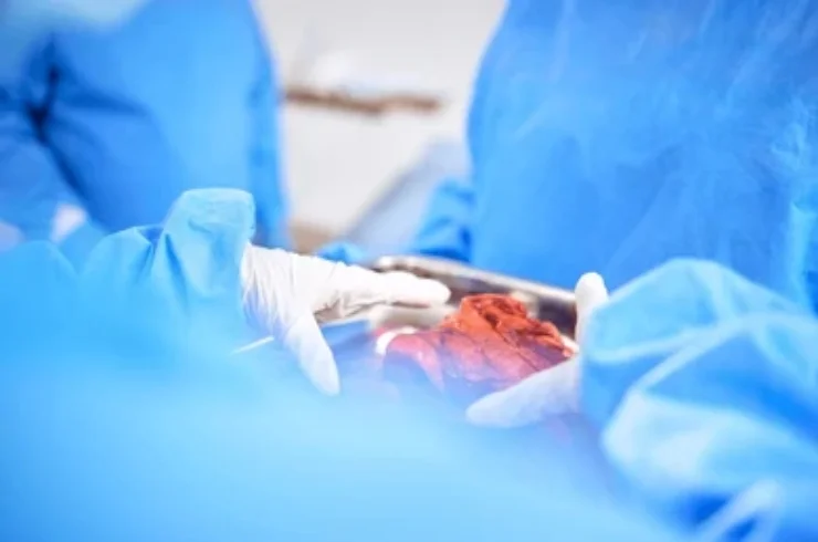 Liver Surgery